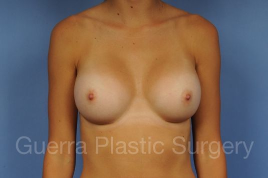 prev Case #1001094 After