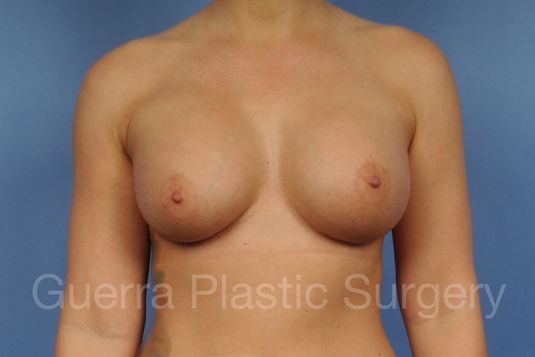 next Case #1001096 After