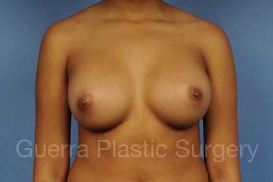 prev Case #1001097 After