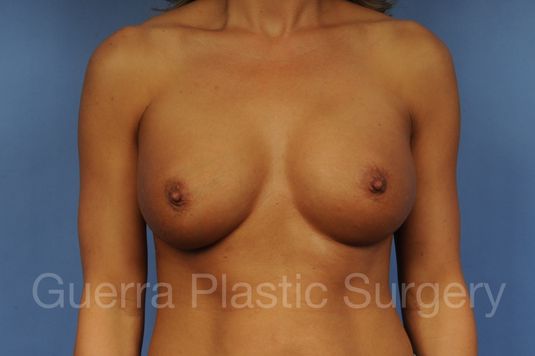 prev Case #1001099 After