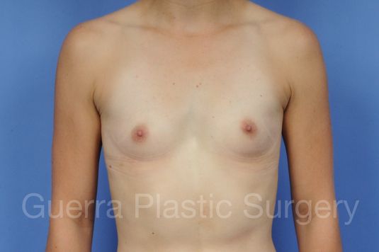 prev Case #1001106 Before