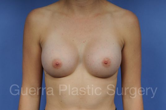 prev Case #1001106 After