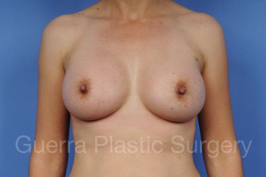 prev Case #1001109 After