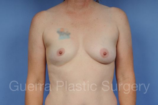 next Case #1001110 Before