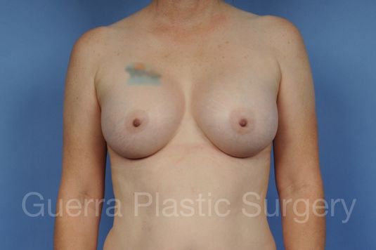 next Case #1001110 After