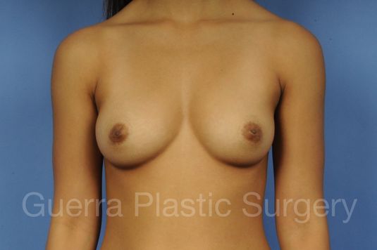 prev Case #1001111 Before