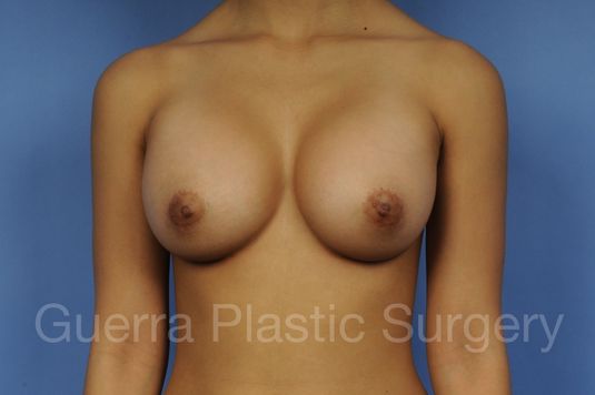 prev Case #1001111 After