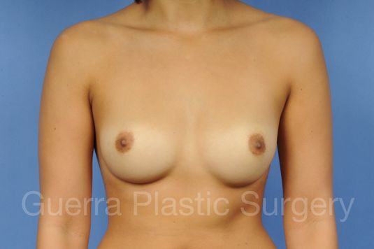 next Case #1001114 Before