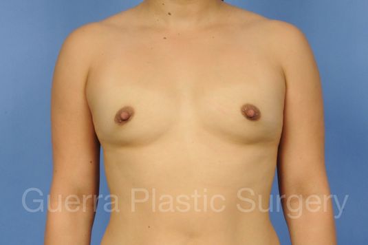 next Case #1001116 Before