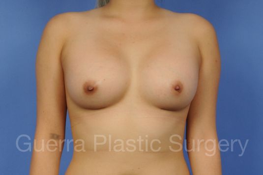 prev Case #1001118 After