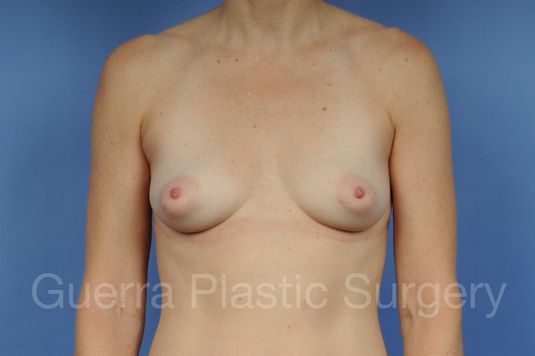 next Case #1001122 Before