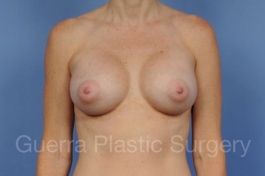 next Case #1001122 After