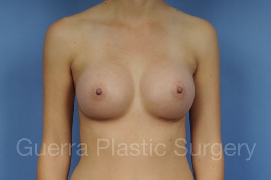 prev Case #1001123 After