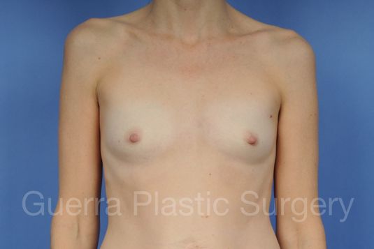 next Case #1001131 Before