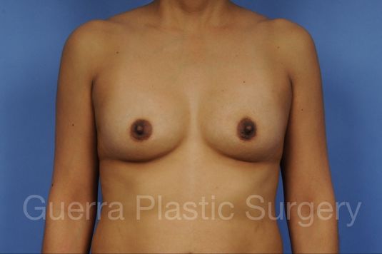 next Case #1001135 Before