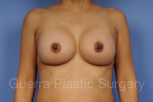 next Case #1001135 After