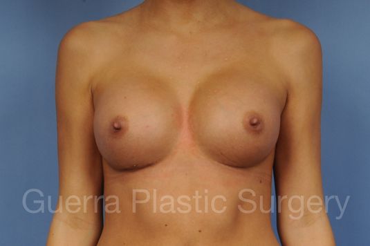 prev Case #1001138 After