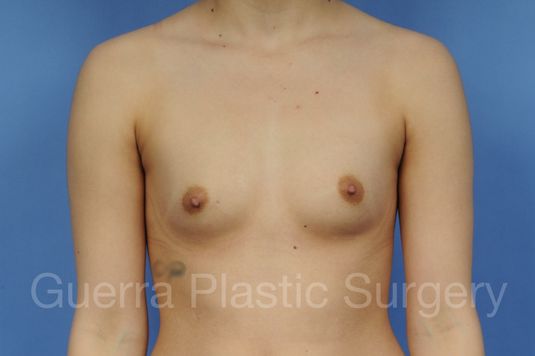 next Case #1001139 Before