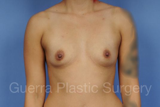 next Case #1001140 Before