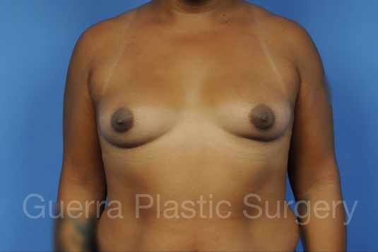 next Case #1001142 Before