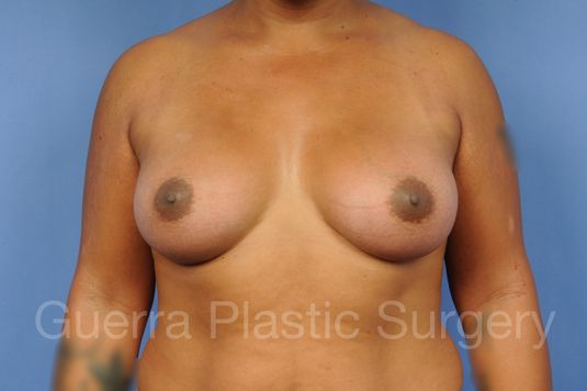 next Case #1001142 After