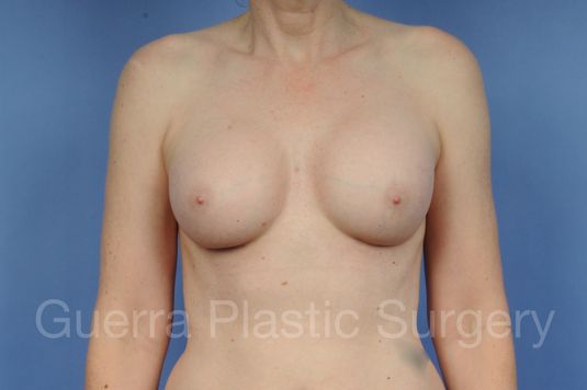 prev Case #1002042 After