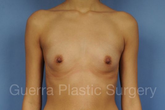 next Case #1002044 Before