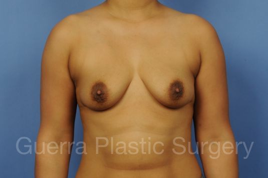 next Case #1002045 Before