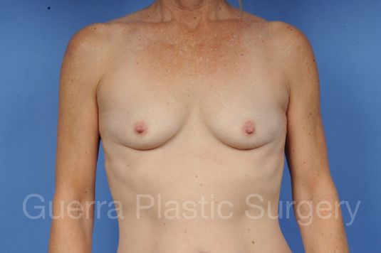 next Case #1002048 Before