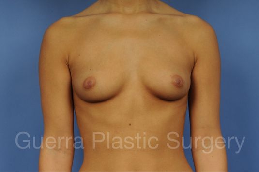 next Case #1001144 Before