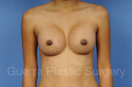 prev Case #1001146 After