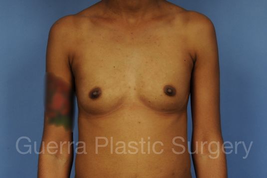 next Case #1001148 Before