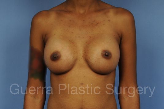 next Case #1001148 After