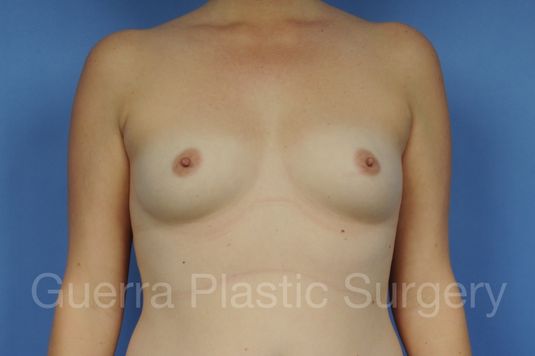 next Case #1001153 Before