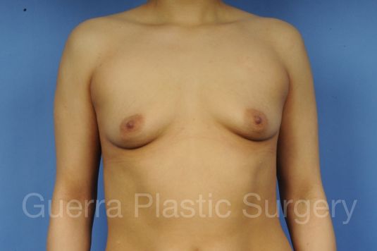 next Case #1001154 Before