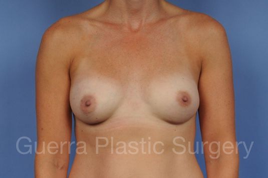 next Case #1001156 After