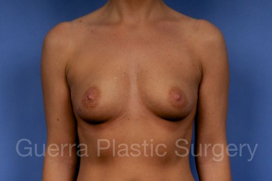 next Case #1001162 Before