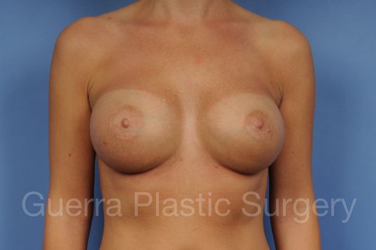 next Case #1001162 After