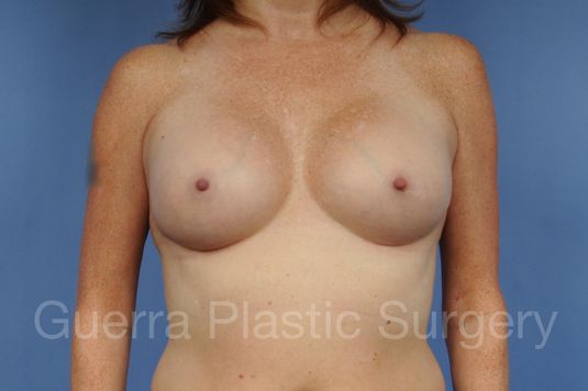 prev Case #1001163 After