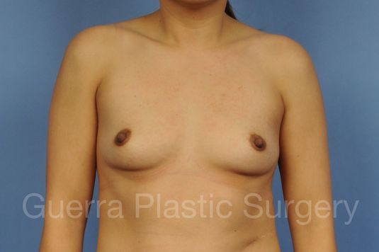 next Case #1001164 Before