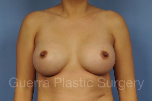 next Case #1001164 After