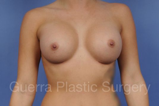 prev Case #1001165 After