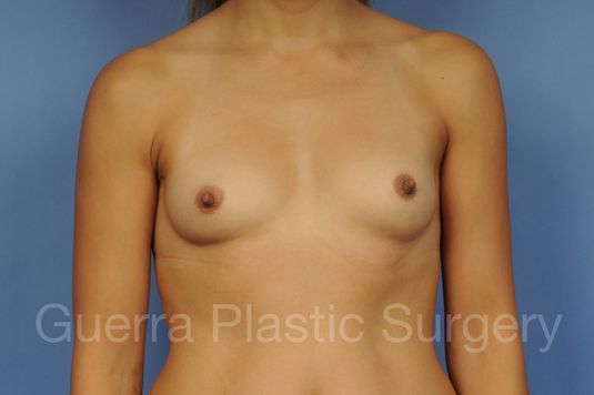 next Case #1001166 Before