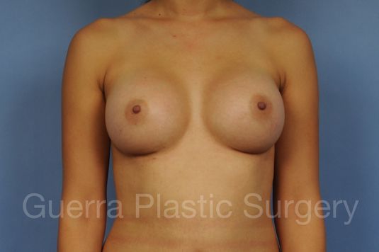 prev Case #1001168 After