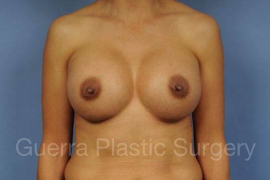 next Case #1001170 After