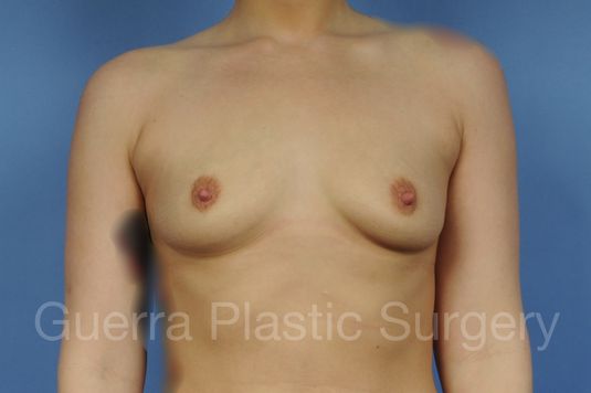 next Case #1001172 Before