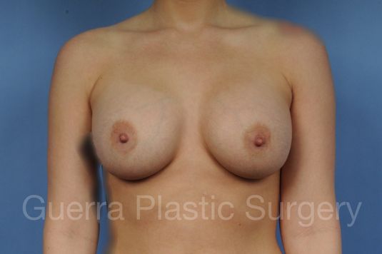 next Case #1001172 After