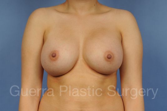 prev Case #1001173 After