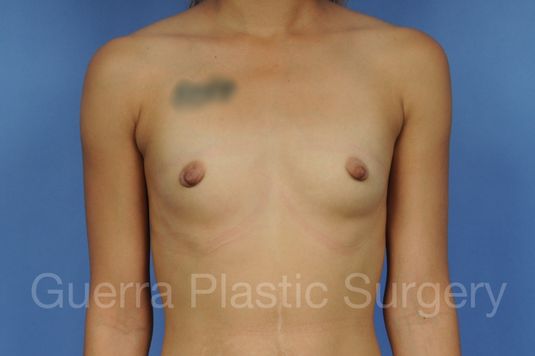 next Case #1002152 Before