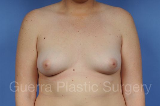 prev Case #1003021 Before